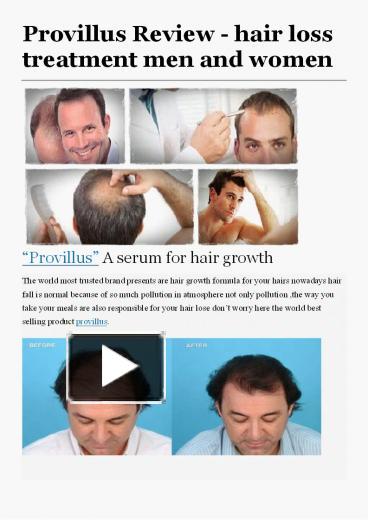 Ppt Provillus Review Hair Loss Treatment Men And Women