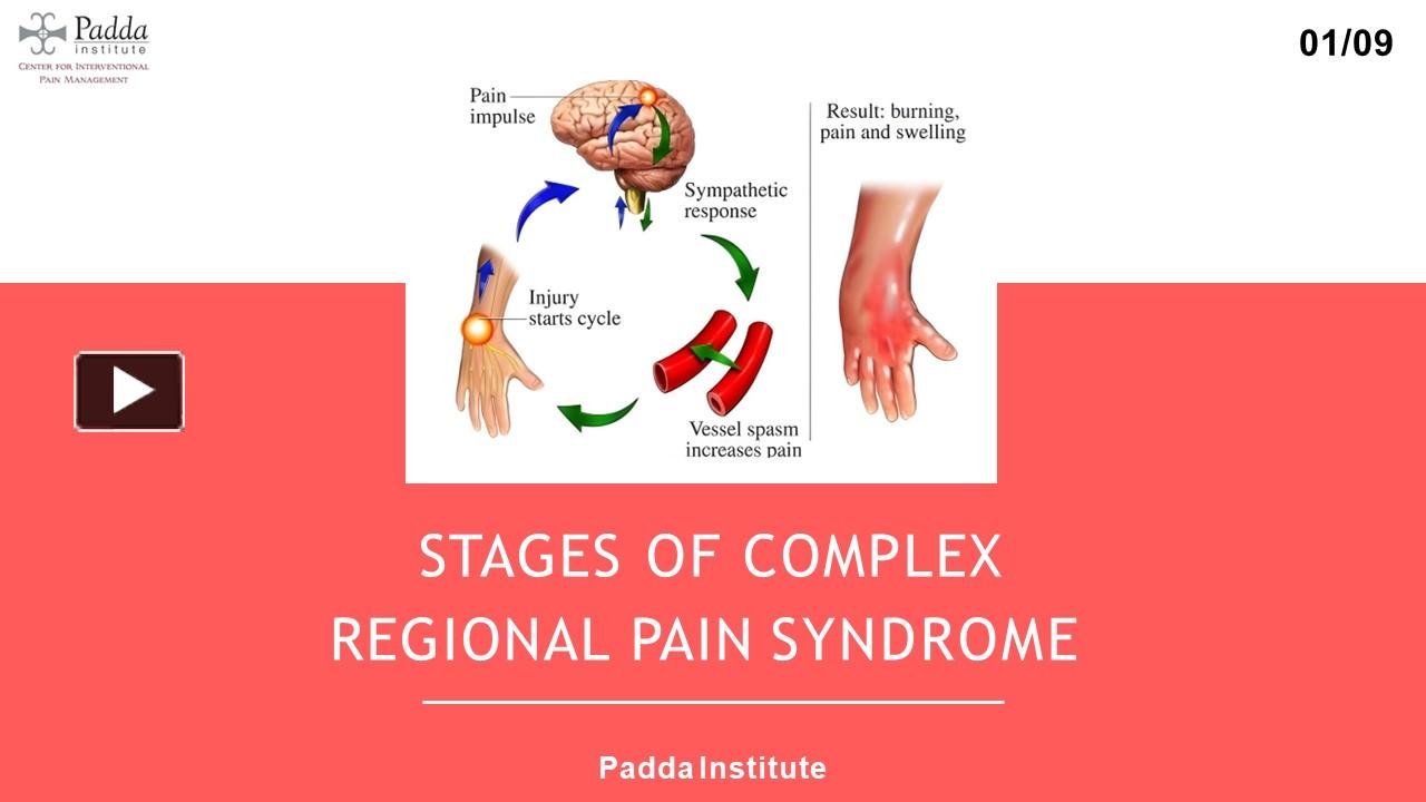 PPT Stages Of Complex Regional Pain Syndrome PowerPoint presentation