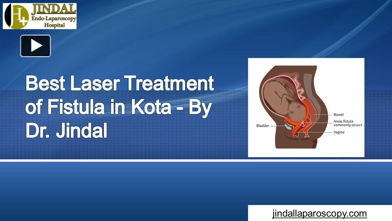 PPT Best Laser Treatment of Fistula in Kota By Dr. Jindal