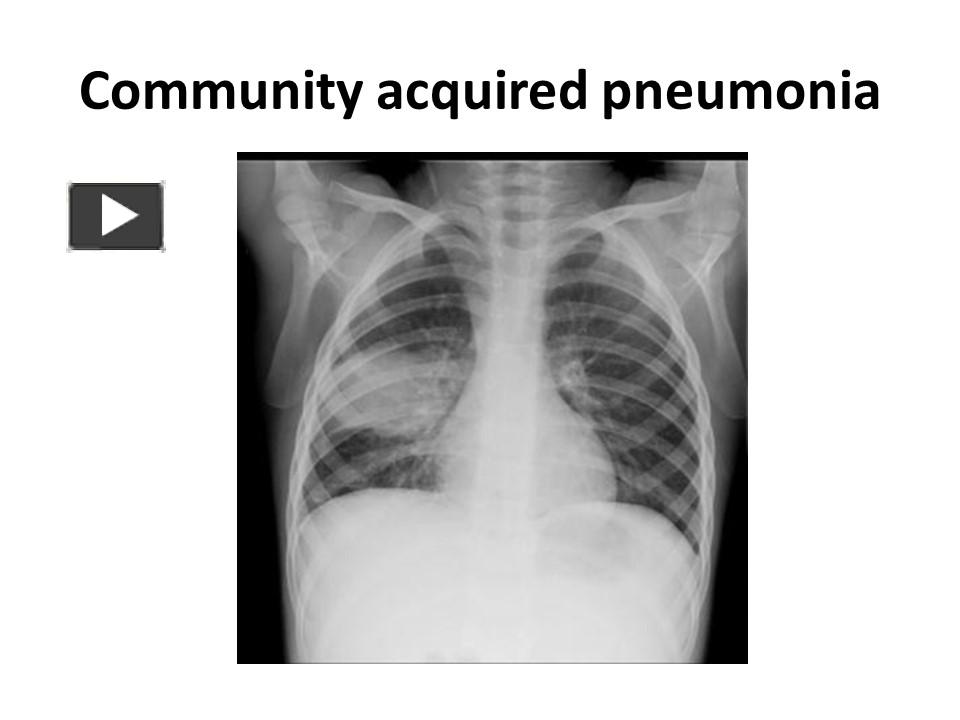 PPT Community acquired pneumonia and Bronchiolitis reports by Dr