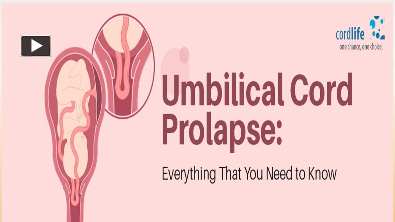 PPT Umbilical Cord Prolapse Everything That You Need To Know