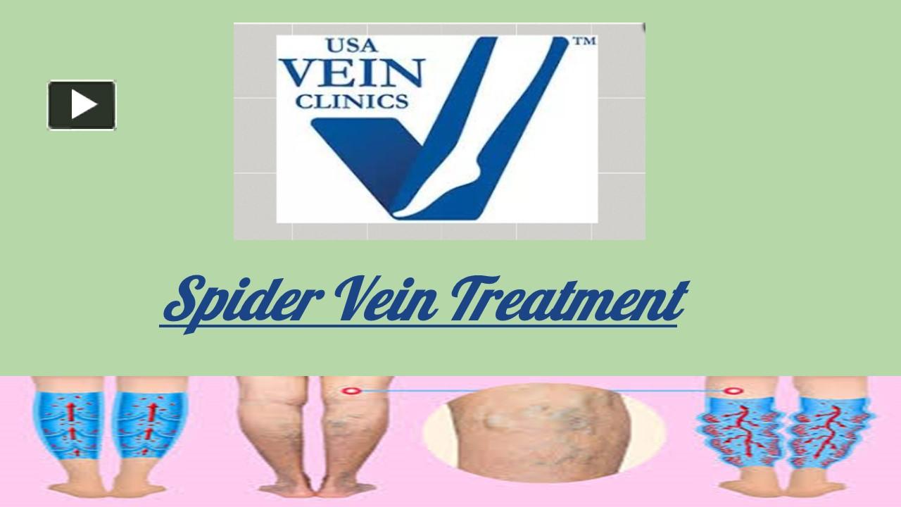 PPT Spider Vein Treatment Center Sclerotherapy USA Vein Clinics