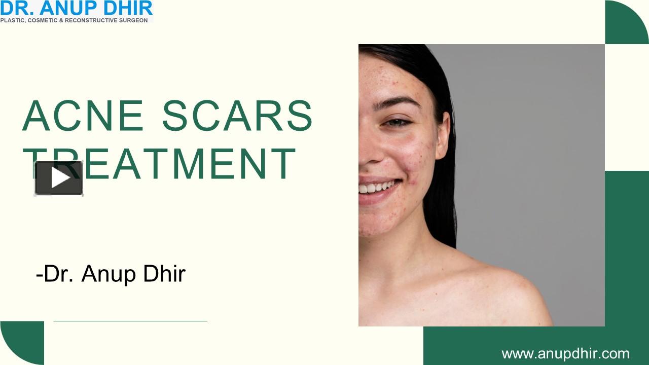 PPT Acne Scar treatment in Delhi Dr. Anup Dhir PowerPoint