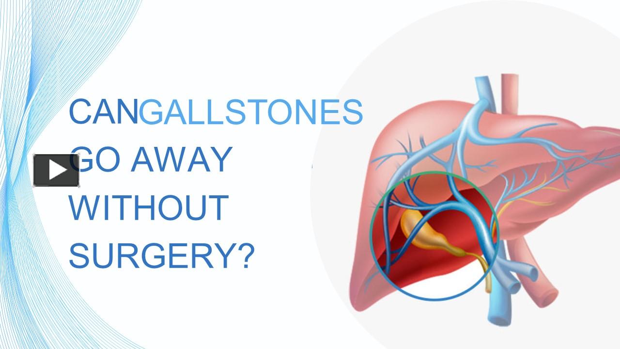 PPT Can gallstones be removed without surgery ? PowerPoint