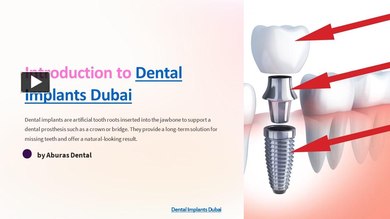 PPT Dental Implants Dubai PowerPoint presentation free to download