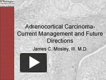 Adrenocortical Carcinoma Current Management and Future Directions ...