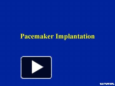 Pacemaker Implantation presentation | free to view