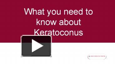 Keratoconus Presentation Free To Download