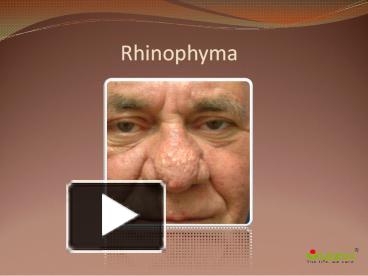 Rhinophyma: Causes, Symptoms, Daignosis, Prevention and Treatment ...