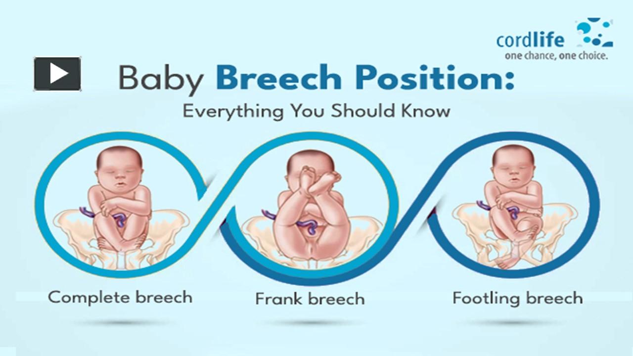 PPT – Baby Breech Position: Everything You Should Know PowerPoint ...