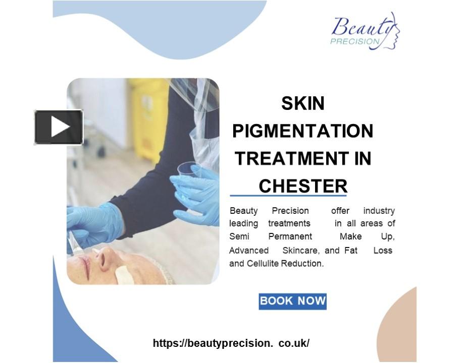 Skin Pigmentation Treatment In Chester Presentation Free To Download